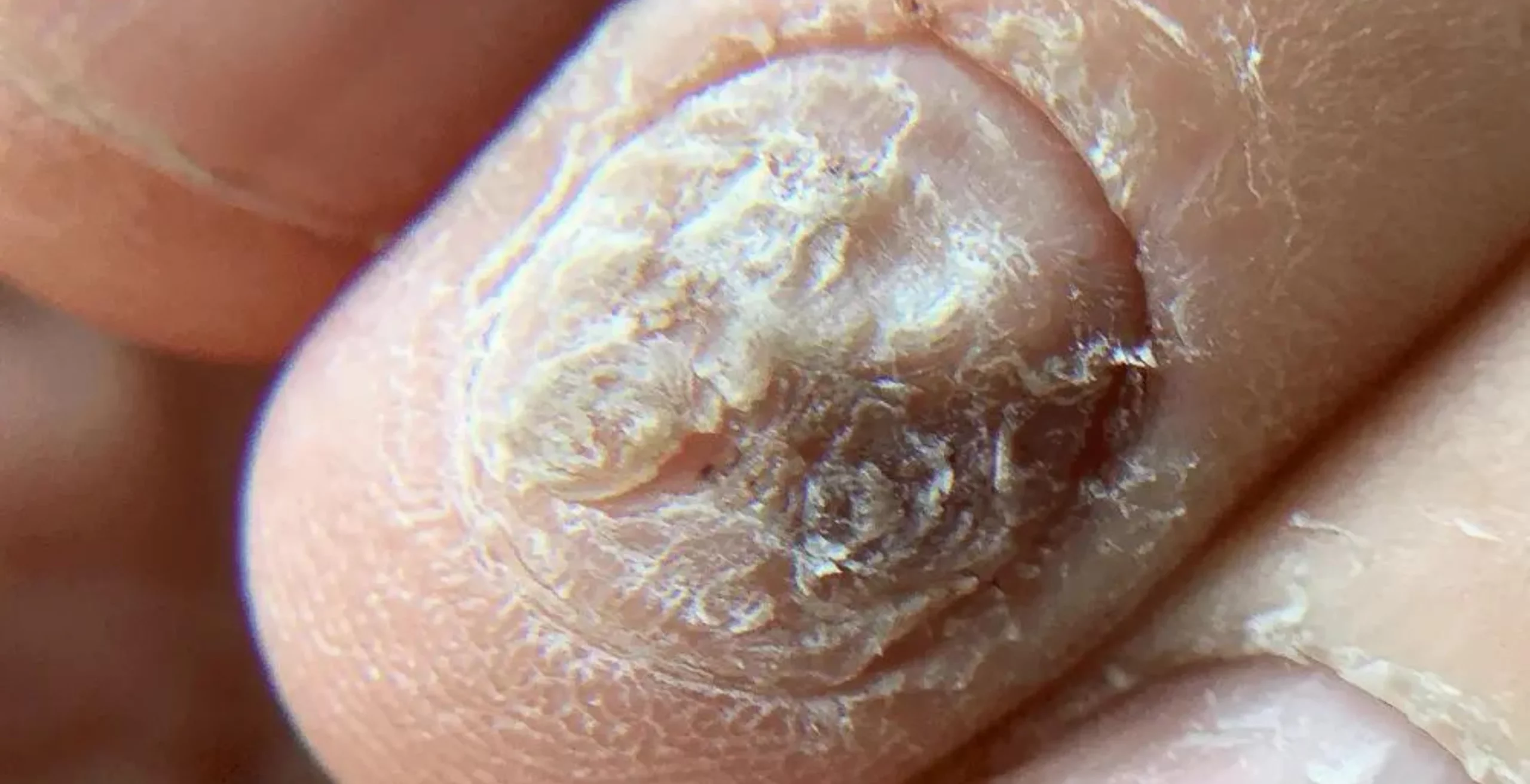 Fungos nas unhas : Como diagnosticar, tratar e evitar